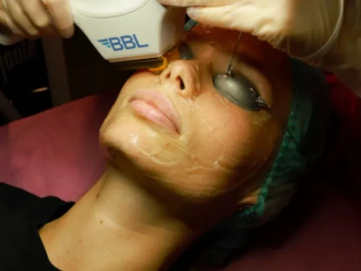 BBL laser treatment in progress at the WinWay clinic